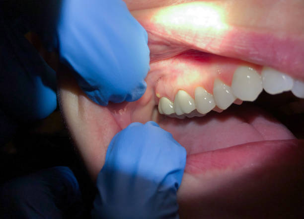 Best Emergency Dentist for Lost Fillings or Crowns in Deltana, AK